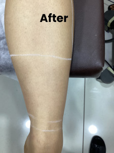 Leg LHR-1 (2)