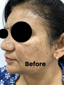 Melasma-1