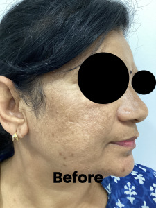 Melasma1-2