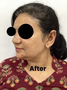 Melasma2-1