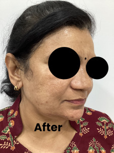 Melasma2-2