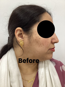 Mole removal1 (1)