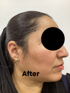 Mole removal1 (2)