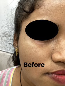 Vitiligo 1 (1)