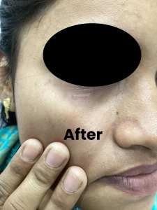 Vitiligo 1 (2)