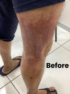 eczema-1 (1)