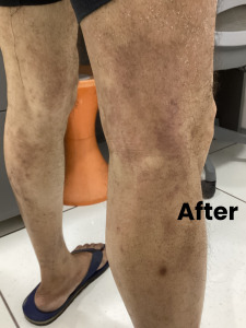 eczema-1 (2)