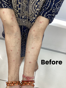 psorasis1 (1)