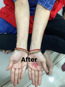 psorasis1 (2)